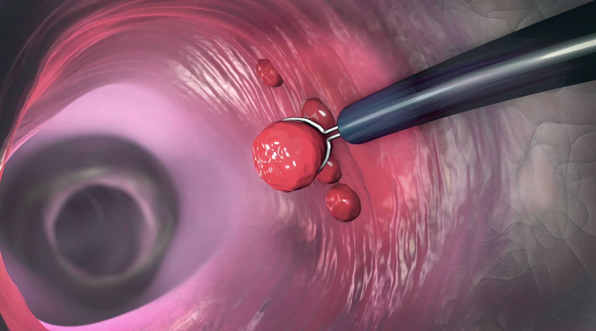 colonoscopy-with-polyp-removal-youtube