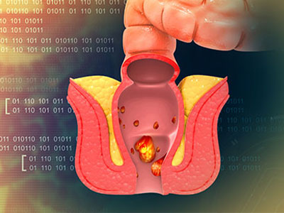 Haemorrhoids